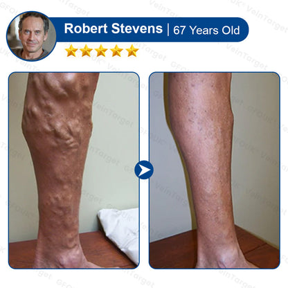💟💟GFOUK® VeinPulse Advanced Transdermal Microneedle System⚡Instant Relief, Long-Term Results
