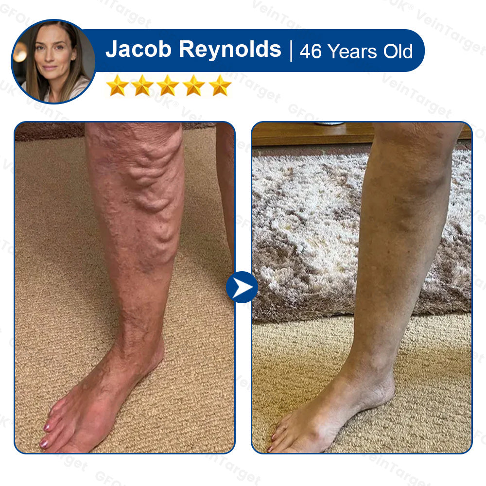 💟💟GFOUK® VeinPulse Advanced Transdermal Microneedle System⚡Instant Relief, Long-Term Results