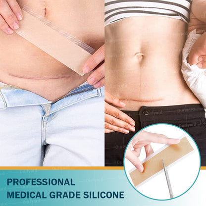 🍀Official Store |Ourlyard® Hyaluronic Acid Nano Microneedle Repair Tape🗽🎉(Treatment of old and new scars, reduction of surgical scars, stretch marks, keloids, acne, burns, warts, dermatomes and varicose veins)