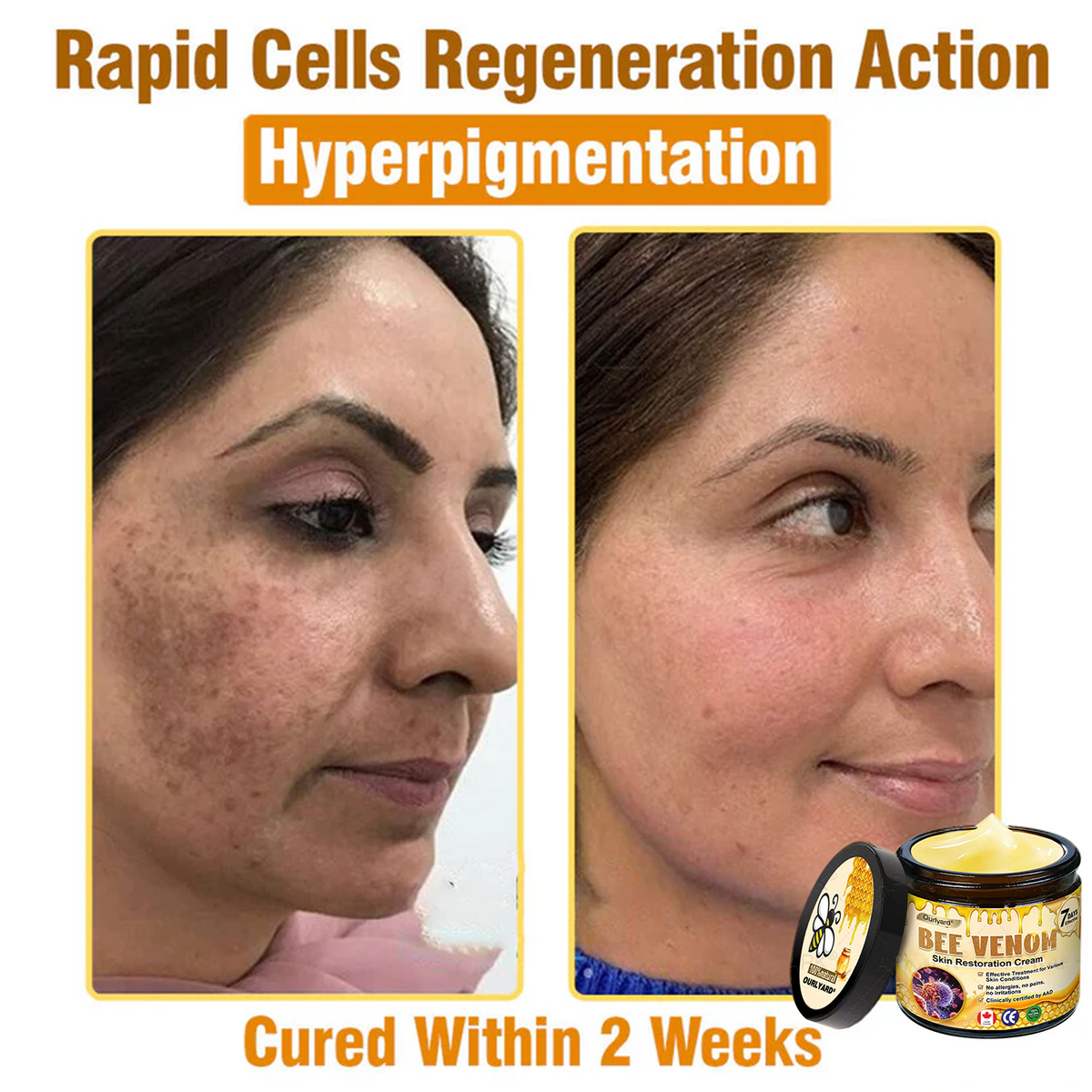 🍁Ourlyard® Bee venom Pro Comprehensive Cream — 🔥Limited Time 80% OFF🔥