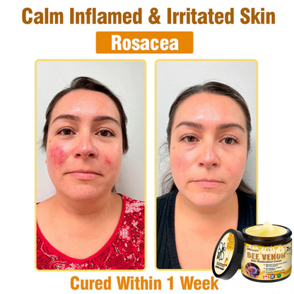 🍁Ourlyard® Bee venom Pro Comprehensive Cream — 🔥Limited Time 80% OFF🔥