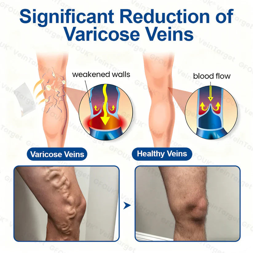 💟💟GFOUK® VeinPulse Advanced Transdermal Microneedle System⚡Instant Relief, Long-Term Results