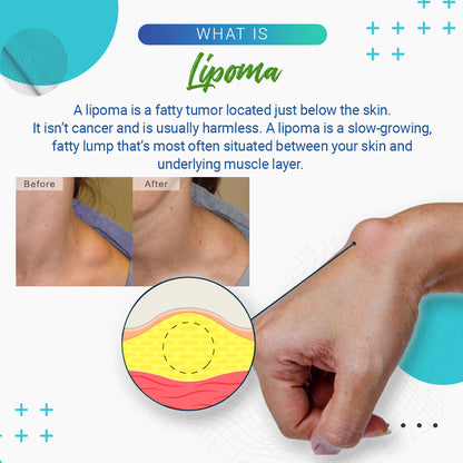 LumpFree™ Lipoma Removal Cream