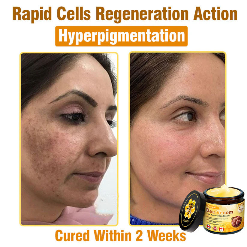 🌤️FDA Approved: Ourlyard® Bee Venom Skin Restoration Cream — 🥇Limited Time 80% OFF🔥