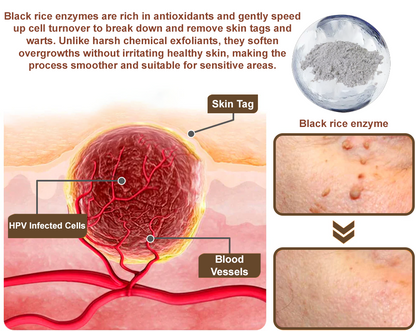 🌊💎Zvoevo® Black Rice Skin Repair Essence Cream ⚕️ FDA Certified (Removes warts and skin growths, improves keratin buildup and seborrheic dermatitis, follicular keratosis, age spots, and bruising)
