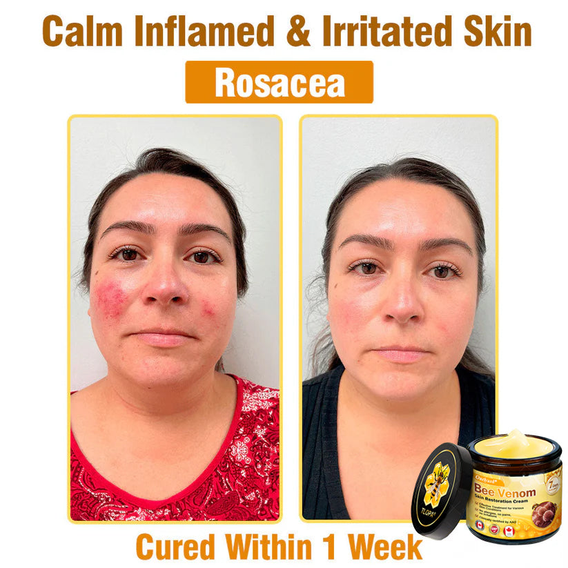 🌤️FDA Approved: Ourlyard® Bee Venom Skin Restoration Cream — 🥇Limited Time 80% OFF🔥