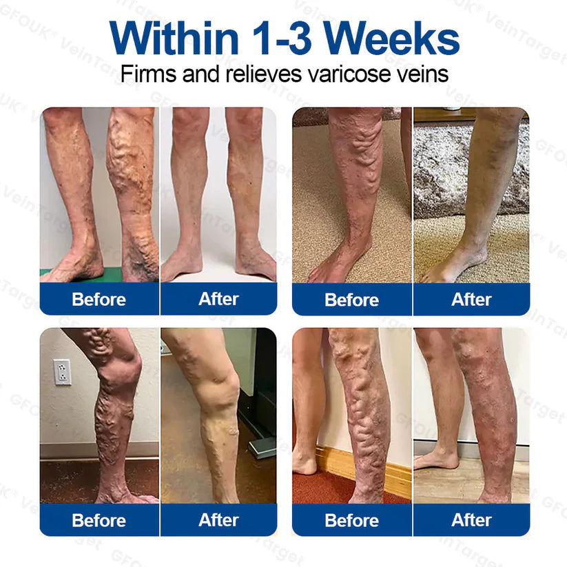 💟💟GFOUK® VeinPulse Advanced Transdermal Microneedle System⚡Instant Relief, Long-Term Results