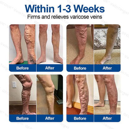 💟💟GFOUK® VeinPulse Advanced Transdermal Microneedle System⚡Instant Relief, Long-Term Results