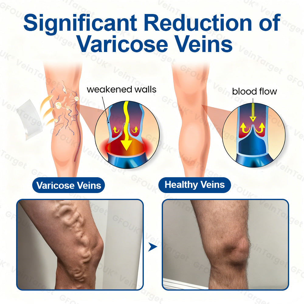 💟💟GFOUK® VeinPulse Advanced Transdermal Microneedle System⚡Instant Relief, Long-Term Results