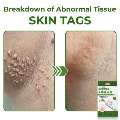 💗Final 3 Hours: 80% OFF - CQGCQGQ® Magnesium MicroNeedle Quick Remove Skin Tag Patches