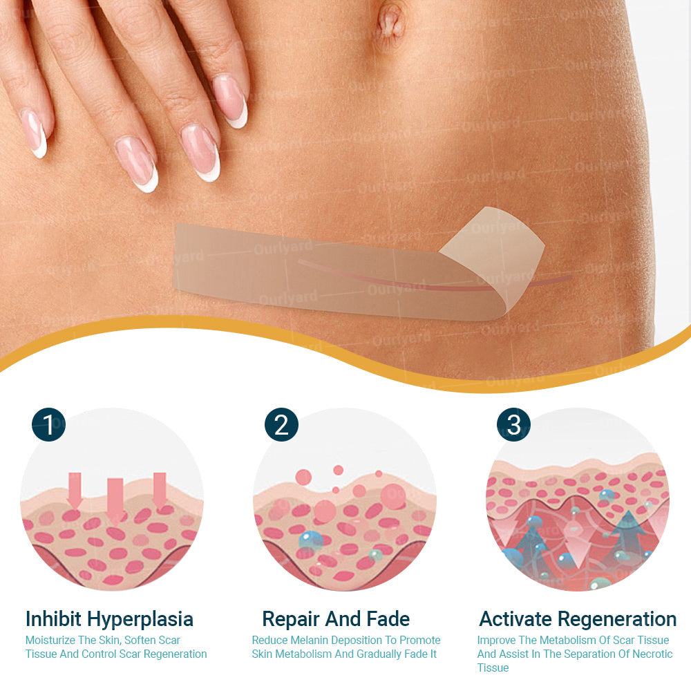 🍀Official Store |Ourlyard® Hyaluronic Acid Nano Microneedle Repair Tape🗽🎉(Treatment of old and new scars, reduction of surgical scars, stretch marks, keloids, acne, burns, warts, dermatomes and varicose veins)